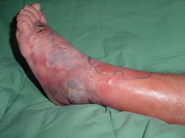 How Long Does It Take For Antibiotics To Clear Cellulitis